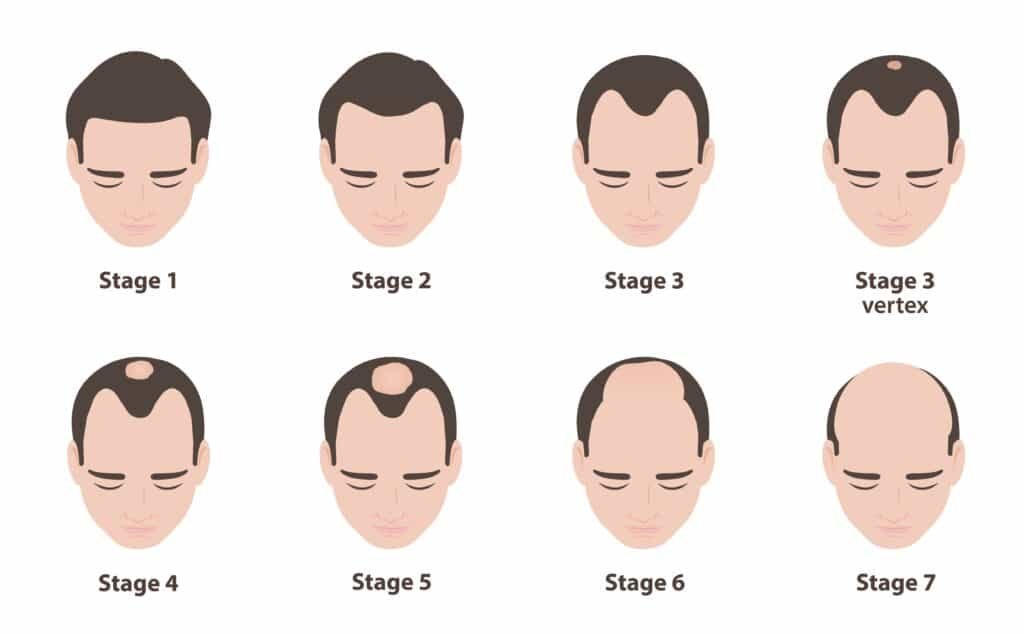 Norwood Hamilton Scale
